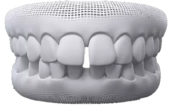 Diastema
